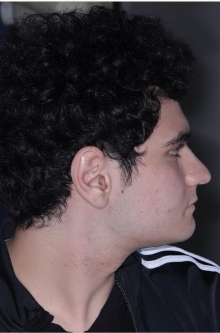 Case 01, Same patient side profile after non-surgical bite correction with restored chin projection