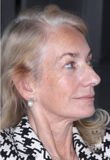Case 02, Female patient after non-surgical Class II to Class I correction