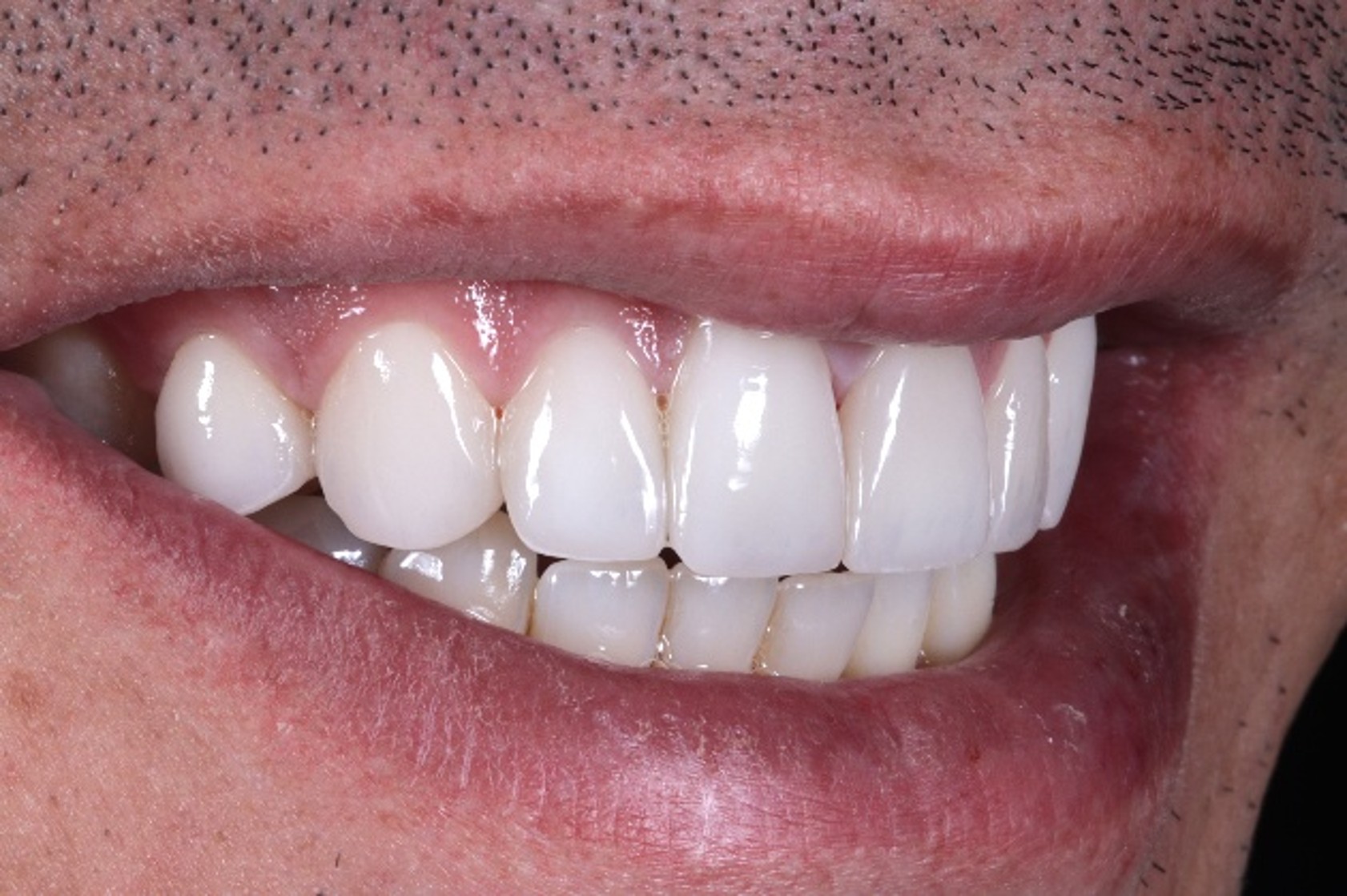 Case 07, Non-surgical open bite and class bite Correction