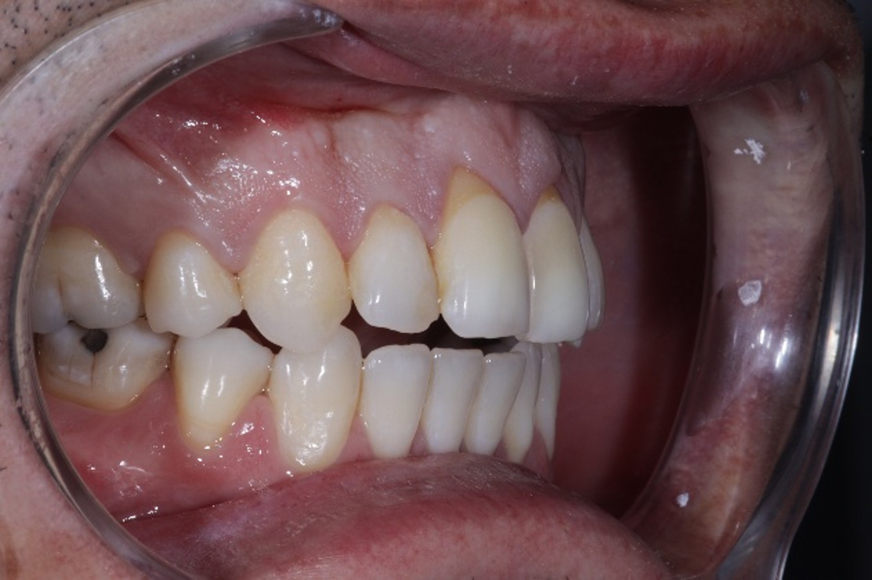 Case 07, Non-surgical open bite and class bite Correction